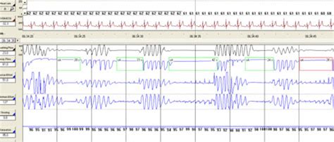 interpreting sleep study results|johns hopkins sleep study.